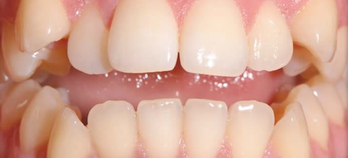 Ortodontinis gydymas 4 3