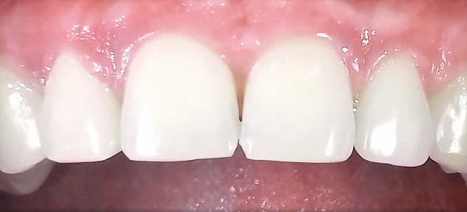 Ortodontinis gydymas 7 4
