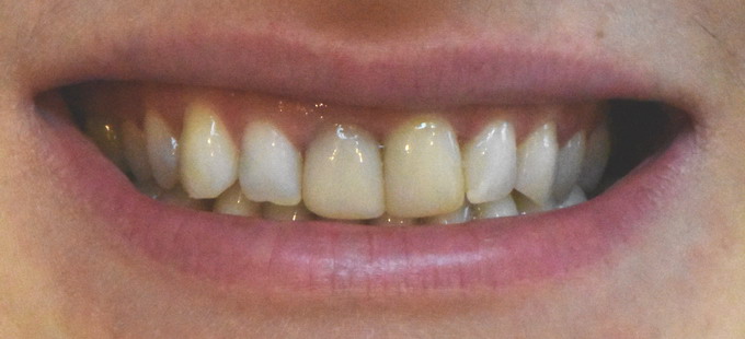 Dantų protezavimas 5 1