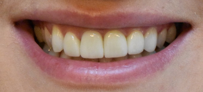 Dantų protezavimas 5 2