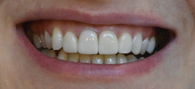 Dantų protezavimas 5 3