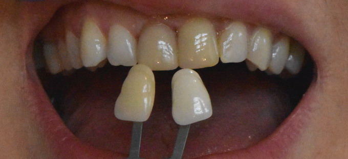 Dantų protezavimas 5 4