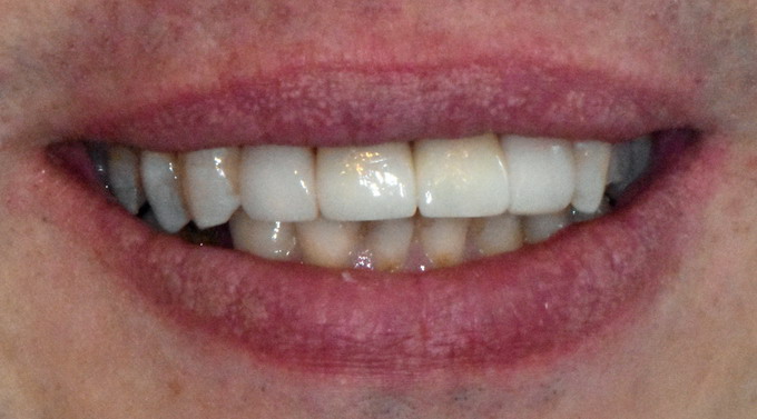 Dantų protezavims 10 2