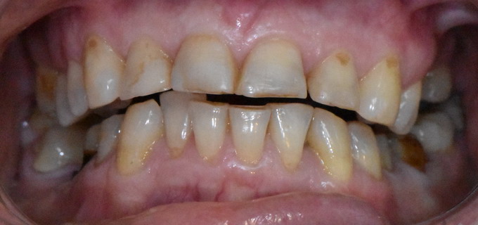 Dantų protezavimas 11 1