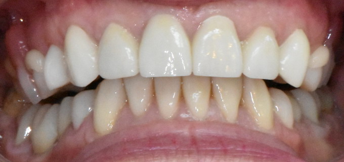 Dantų protezavimas 11 2