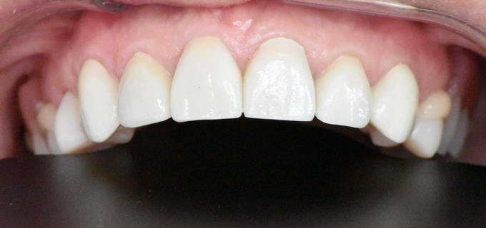 Dantų protezavimas 11 4