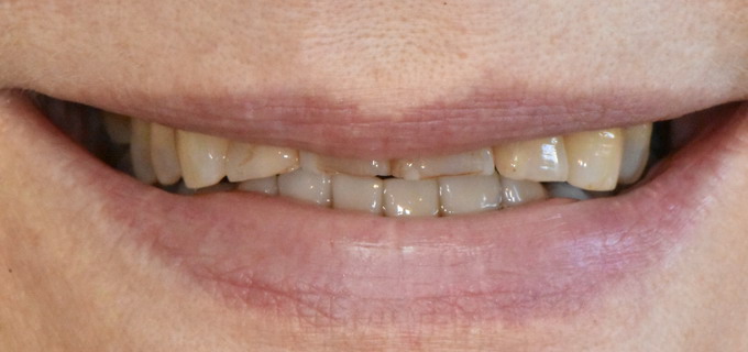 Dantų protezavimas 11 5