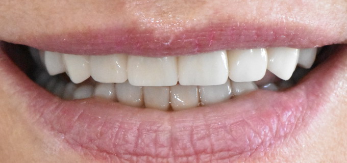 Dantų protezavimas 11 6