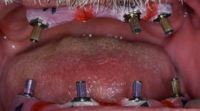 Dantų implantavimas 13 1