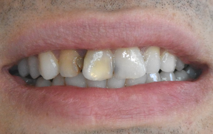 Dantų protezavimas 13a 1