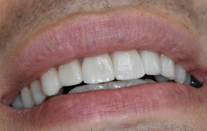 Dantų protezavimas 13a 2