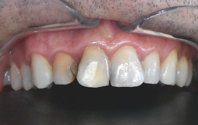 Dantų protezavimas 13a 3