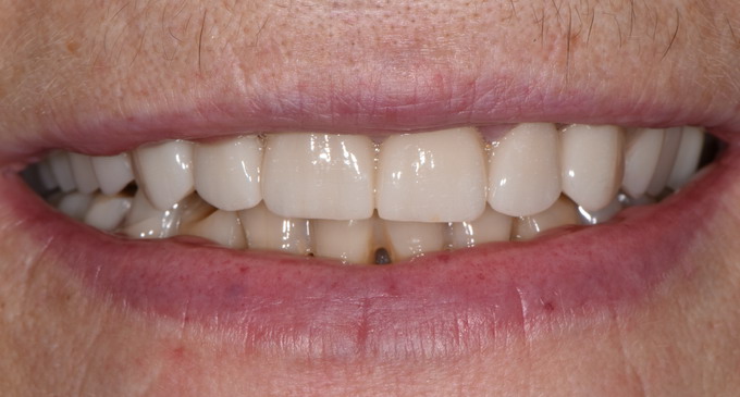 Dantų protezavimas 18 2