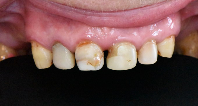 Dantų protezavimas 18 3