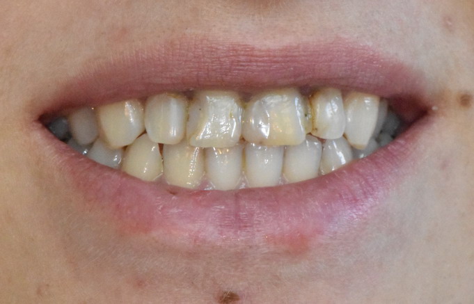Dantų protezavimas prieš ir po 20 1
