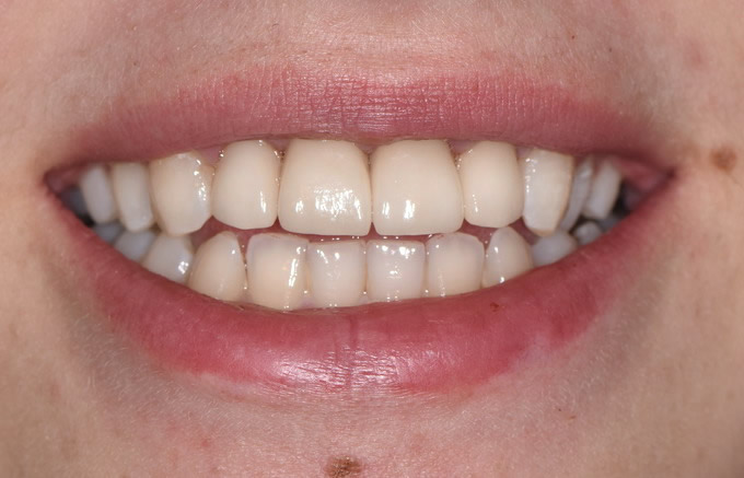 Dantų protezavimas prieš ir po 20 2