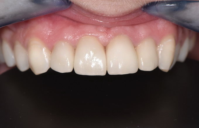 Dantų protezavimas prieš ir po 20 4