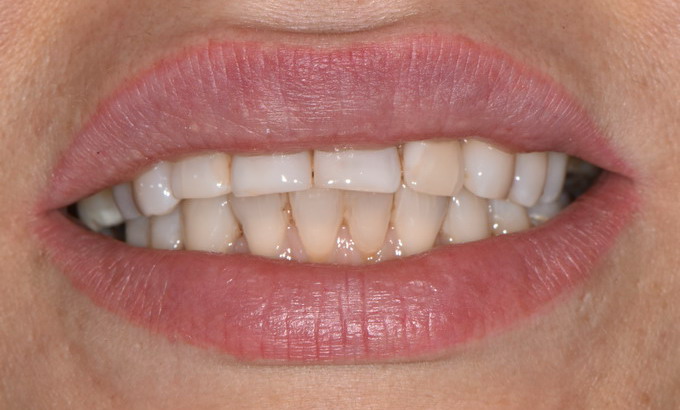 Dantų protezavimas prieš ir po21 1
