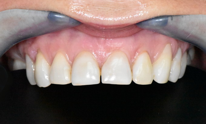 Dantų protezavimas prieš ir po21 3
