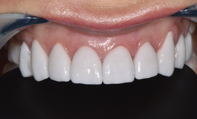 Dantų protezavimas prieš ir po21 4