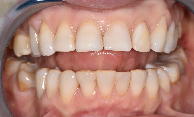 Dantų protezavimas prieš ir po21 5