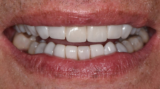 Dantų protezavimas prieš ir po nuotraukos 22 2
