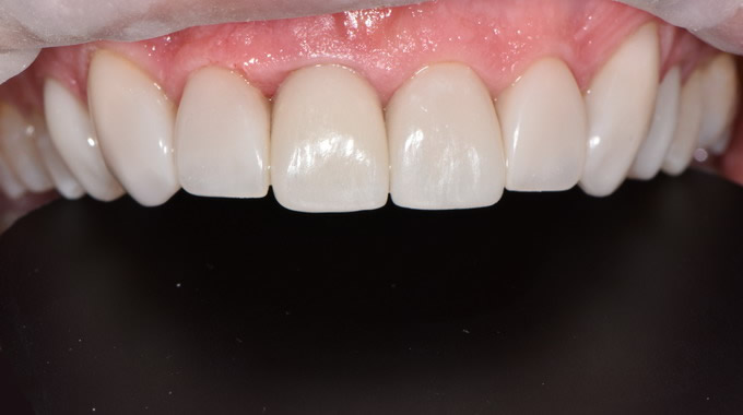 Dantų protezavimas prieš ir po nuotraukos 22 4